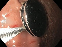 Meski Tertelan dan Bersemayam di Perut, Fitness Tracker Ini Masih Berfungsi