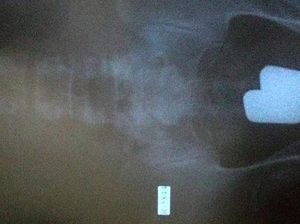 Edan! Traveler Selundupkan Emas di Dalam Anus