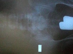 Edan! Traveler Selundupkan Emas di Dalam Anus