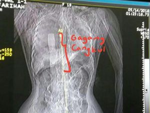 Ini Hasil Rontgen Gagang Cangkul di Tubuh Eno Korban Pembunuhan Sadis
