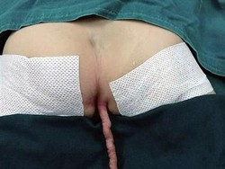 Kondisi Bawaan Lahir, Bocah Lelaki Ini Punya Ekor Sepanjang 15 Cm