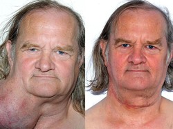 Kisah Ian, Hidup 25 Tahun dengan Tumor Sebesar Melon di Leher