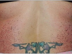 Karena Sebab Misterius, Ribuan Tahi Lalat Tumbuh Mendadak Pada Wanita Ini