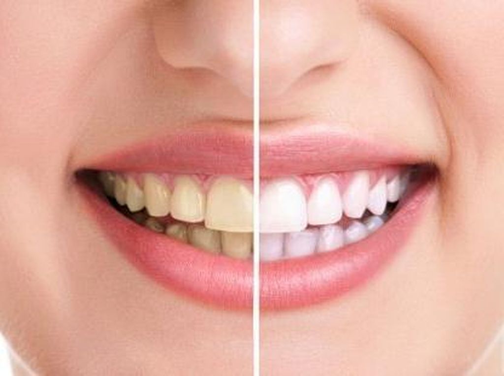 Tanpa Disadari, Diam-diam 5 Hal Ini Bikin Gigi Tak Putih Cemerlang