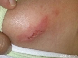 Tiba-tiba Muncul Semacam Luka Lepuh di Kulit Bayi, Apa Sebabnya?