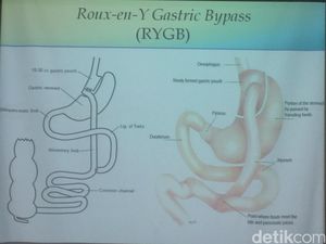 BMI di Bawah 30 Tapi Hendak Jalani Operasi Bariatrik, Bolehkah?
