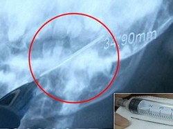 Ngeri! Bayi 1 Tahun Ini Tak Sengaja Telan Jarum Sepanjang 4 Cm