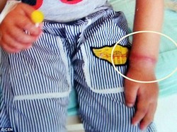 Garis Merah Dikira Bekas Gelang, Tak Tahunya Karet Gelang Tumbuh di Tangan