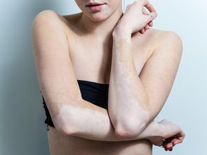 Hari Vitiligo Sedunia 2024, Kenali Sejarah dan Tema Peringatannya