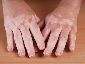 Kenali Vitiligo, Bercak pada Kulit yang Tak Berbahaya Kenali Vitiligo, Bercak pada Kulit yang Tak Berbahaya