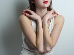 Prosedur Terapi Vitiligo: Terapi Jemur Hingga Tandur Kulit