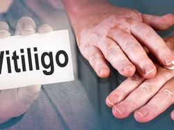 Vitiligo, Penyakit yang Bikin Kulit Memudar Jadi Warna Putih Susu