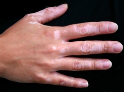 Vitiligo Tak Bisa Sembuh 100 Persen? Ini Kata Dokter