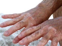 Di Area Tubuh Ini Umumnya Vitiligo Lebih Sering Muncul