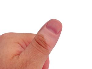 Sama-sama Muncul Bercak Putih di Kulit, Ini Bedanya Vitiligo dan Panu