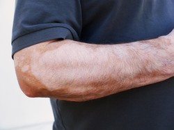 Vitiligo Berpotensi Sebabkan Gangguan Pendengaran, Begini Penjelasan Dokter
