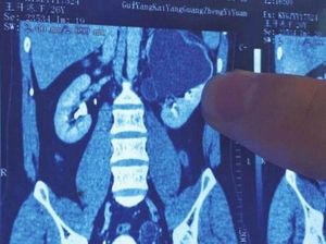 Gara-gara Sakit Perut, Pria Ini Ketahuan Punya 4 Ginjal di Tubuhnya