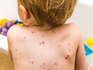 Gejala Cacar Air dan Cara Mengobatinya Paling Ampuh