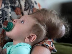 Kalahkan Prediksi, Bayi dengan Otak di Luar Kepala Kini Sudah Berusia 7 Bulan