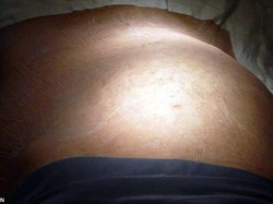 Perut Membuncit, Ternyata Tumbuh Tumor Sebesar Bola Basket