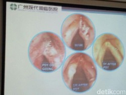 Inilah Teknik Mujarab Untuk Sembuhkan Pasien Kanker Pita Suara