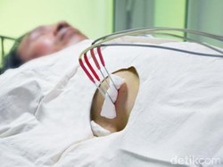 Mengintip Cara Kerja Cryosurgery untuk Membunuh Kanker