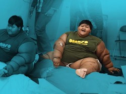 Penyebab Arya Berbobot hingga 190 Kg Belum Diketahui: Bisa Hormon atau Genetik