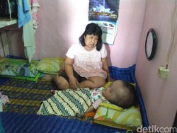 Pemkot Bandung Diminta Bantu Bocah Ririn Penderita Hidrosefalus