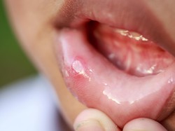 Sedang Sariawan? Cek di Sini Penyebabnya