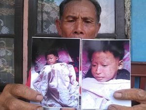 Begini Upaya RSHS Bandung Menyembuhkan Bocah Bersisik