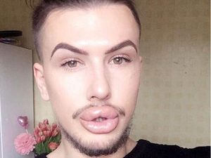 Habiskan Rp 201 Juta, Ini Nasib Pria yang Kebanyakan Filler Bibir