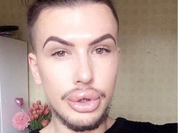 Habiskan Rp 201 Juta, Ini Nasib Pria yang Kebanyakan Filler Bibir