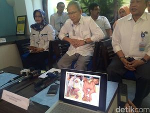 Tantangan Tim Dokter RSCM dalam Memisahkan Kembar Siam Safira-Saqira