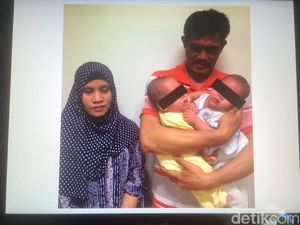 Ortu: Operasi Lancar, Kembar Siam Safira-Saqira Kini Dirawat di PICU RSCM