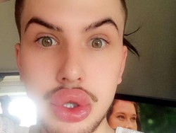 Ingin Mirip Kylie Jenner, Pria Ini Habiskan Rp 360 Jutaan untuk Filler & Botox