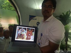 Kembar Siam Dempet Perut Asal Bengkulu Jalani Operasi di RSCM