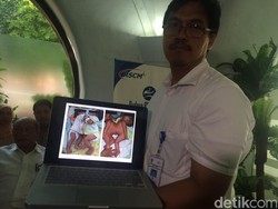 Kembar Siam Dempet Perut Asal Bengkulu Jalani Operasi di RSCM