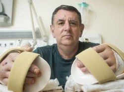 Kedua Tangannya Putus karena Kecelakaan, Pria Ini Dapat Tangan Baru