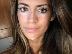 Selalu Tampil Flawless, Ternyata Wajah Asli Model Ini Belang karena Vitiligo