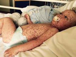 Ruam Selimuti Sekujur Tubuh Balita Ini Gara-gara Cacar Air Parah