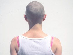 Idap Penyakit Autoimun, Gadis Ini Alami Kebotakan di Usia 20 Tahun