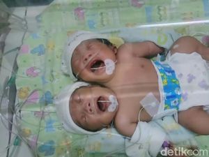 Bayi Berkepala Dua Lahir di Gresik