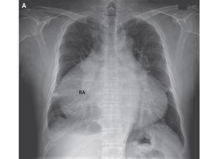 Karena Kondisi Tak Lazim, 80 Persen Dada Pria ini Tertutup Jantung