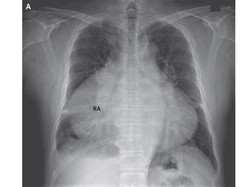 Karena Kondisi Tak Lazim, 80 Persen Dada Pria ini Tertutup Jantung