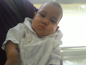 Usai Operasi Pemisahan, Bayi Safira Sempat Muntah dan Tak Bisa BAB