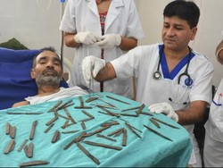 Pria India ini Telan 40 Pisau Selama 3 Bulan, Dokter Berhasil Mengambilnya