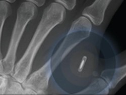 Implan ini Membuat Tangan Manusia Berfungsi Layaknya Remote Control