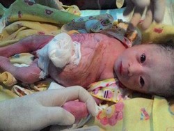 Bayi Lahir Tanpa Lubang Anus, Keluarga Tak Ada Biaya Operasi