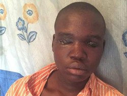 Pria Afrika Dicungkil Matanya untuk Perdukunan