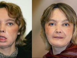 Penerima Transplantasi Wajah Pertama Meninggal Dunia